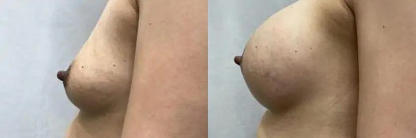 Breast Augmentation Case #2332