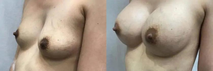 Breast Augmentation Case #2332