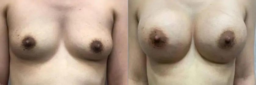 Breast Augmentation Case #2332