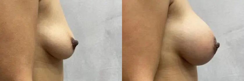 Breast Augmentation Case #2357
