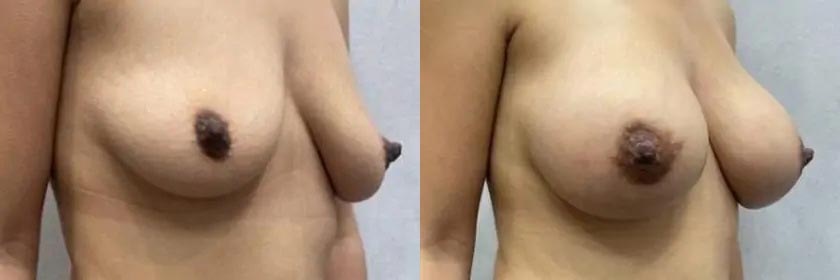 Breast Augmentation Case #2357