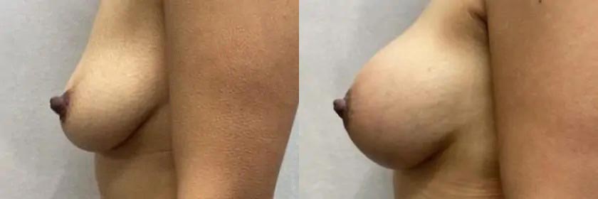 Breast Augmentation Case #2357