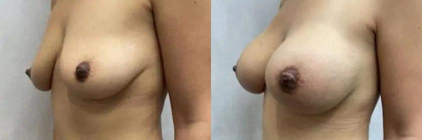 Breast Augmentation Case #2357