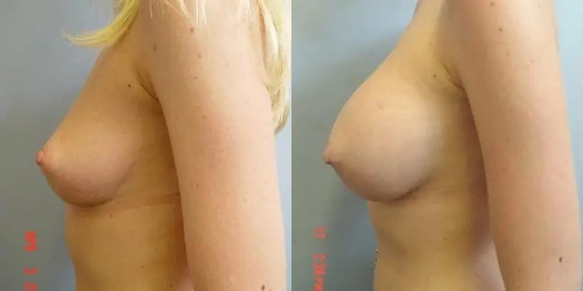 Breast Augmentation Case #2110