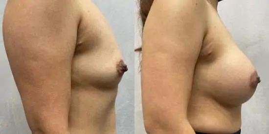 Breast Augmentation Case #2368