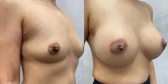 Breast Augmentation Case #2368