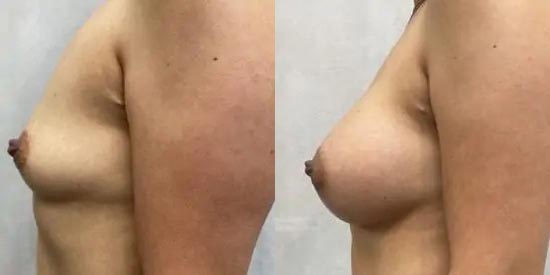 Breast Augmentation Case #2368