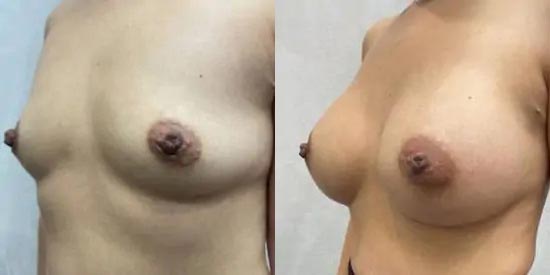 Breast Augmentation Case #2368