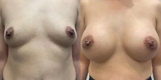 Breast Augmentation Case #2368