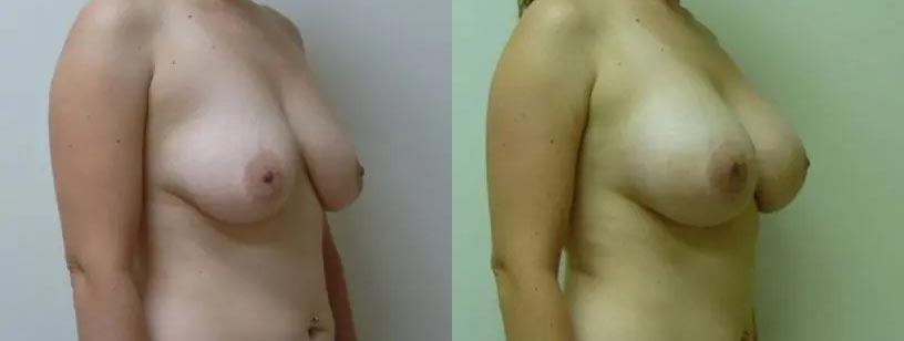 Breast Augmentation Case #2115