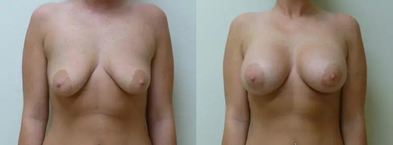 Breast Augmentation Case #2125