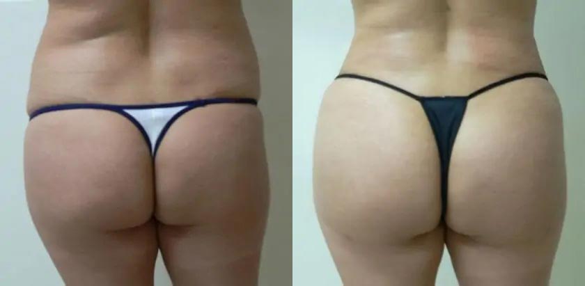 Liposuction Case #1909 Liposuction Case #1909