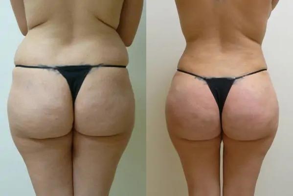 Brazilian Butt Lift Case #1842 Brazilian Butt Lift Case #1842