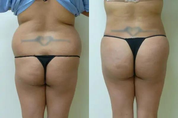 Brazilian Butt Lift Case #1816 Brazilian Butt Lift Case #1816
