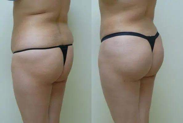 Brazilian Butt Lift Case #1850 Brazilian Butt Lift Case #1850