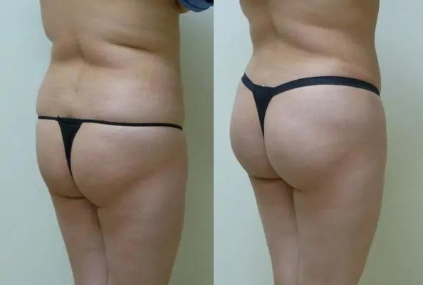 Brazilian Butt Lift Case #1850 Brazilian Butt Lift Case #1850