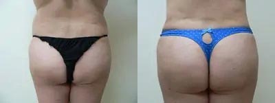 Brazilian Butt Lift Case #1855 Brazilian Butt Lift Case #1855