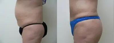Brazilian Butt Lift Case #1855 Brazilian Butt Lift Case #1855