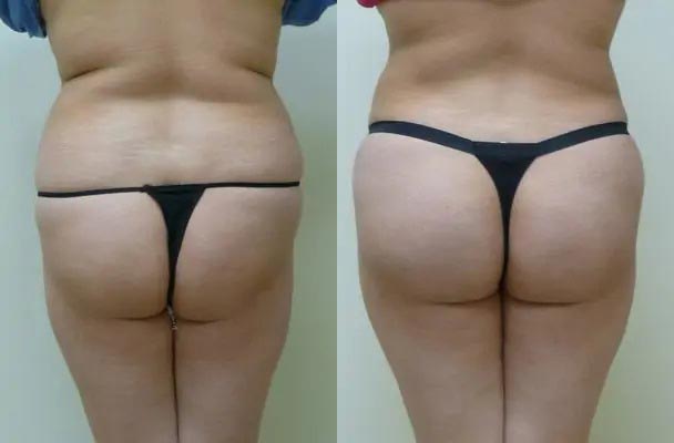 Brazilian Butt Lift Case #1845 Brazilian Butt Lift Case #1845
