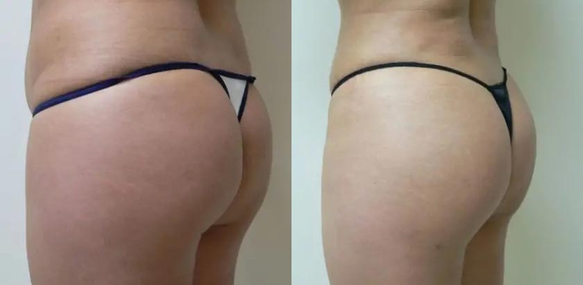 Liposuction Case #1909 Liposuction Case #1909