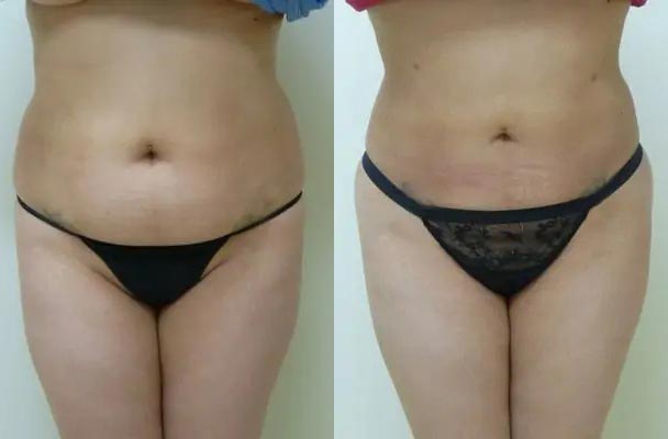 Brazilian Butt Lift Case #1845 Brazilian Butt Lift Case #1845