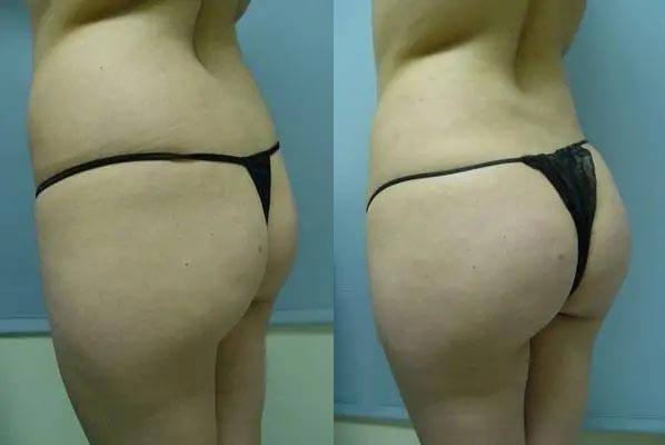 Brazilian Butt Lift Case #1865 Brazilian Butt Lift Case #1865