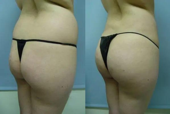 Brazilian Butt Lift Case #1865 Brazilian Butt Lift Case #1865