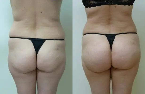 Brazilian Butt Lift Case #1875 Brazilian Butt Lift Case #1875