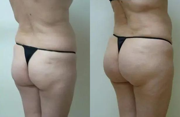 Brazilian Butt Lift Case #1875 Brazilian Butt Lift Case #1875
