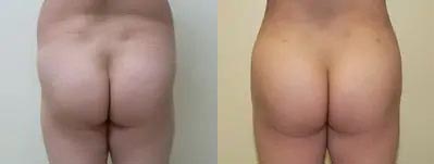 Brazilian Butt Lift Case #1860 Brazilian Butt Lift Case #1860