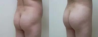 Brazilian Butt Lift Case #1860 Brazilian Butt Lift Case #1860