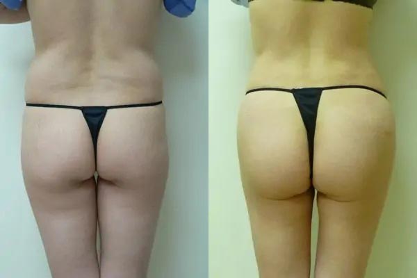 Brazilian Butt Lift Case #1885 Brazilian Butt Lift Case #1885