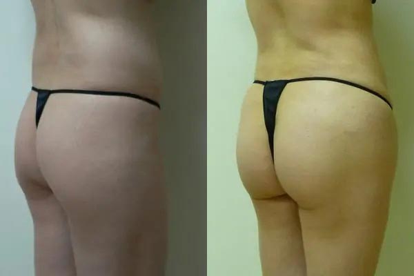 Brazilian Butt Lift Case #1885 Brazilian Butt Lift Case #1885