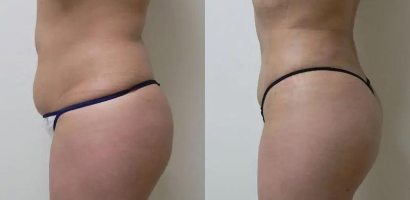 Liposuction Case #1909 Liposuction Case #1909