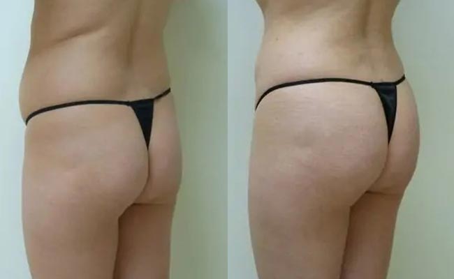 Brazilian Butt Lift Case #1894 Brazilian Butt Lift Case #1894