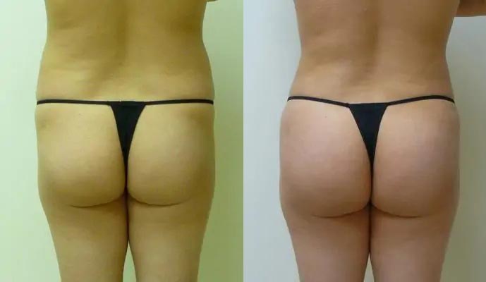 Brazilian Butt Lift Case #1880 Brazilian Butt Lift Case #1880