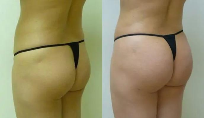 Brazilian Butt Lift Case #1880 Brazilian Butt Lift Case #1880