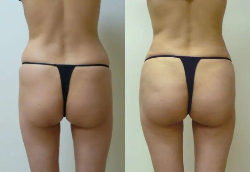 Brazilian Butt Lift Case #1899 Brazilian Butt Lift Case #1899