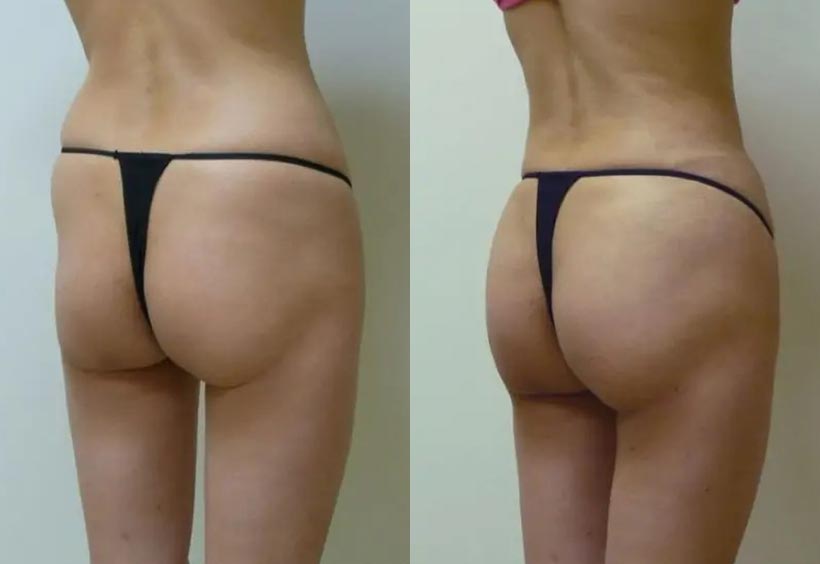 Brazilian Butt Lift Case #1899 Brazilian Butt Lift Case #1899