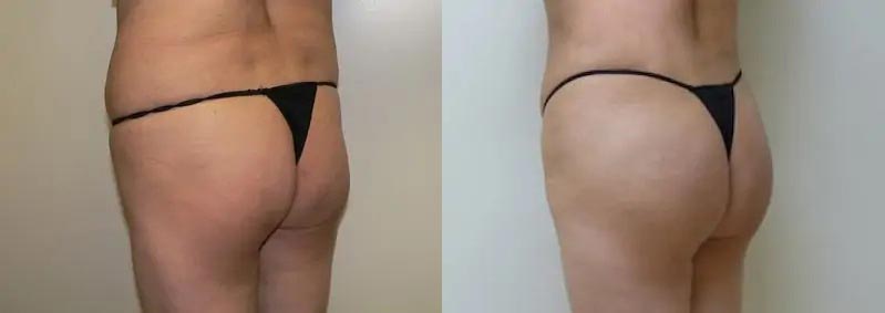 Brazilian Butt Lift Case #1904 Brazilian Butt Lift Case #1904