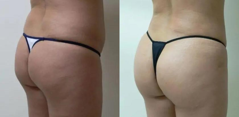 Liposuction Case #1909 Liposuction Case #1909