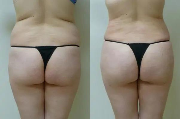 Brazilian Butt Lift Case #1823 Brazilian Butt Lift Case #1823