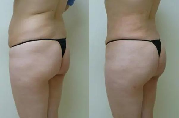 Brazilian Butt Lift Case #1823 Brazilian Butt Lift Case #1823