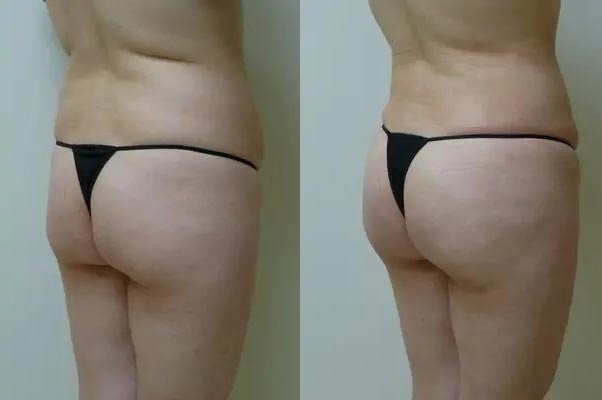 Brazilian Butt Lift Case #1823 Brazilian Butt Lift Case #1823
