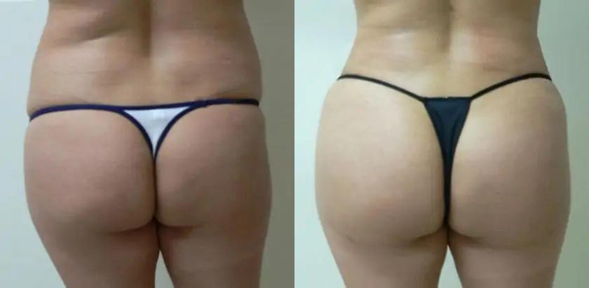 Brazilian Butt Lift at Shine Cosmetic Surgery in West Covina, CA