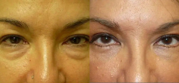 Blepharoplasty Case #2080