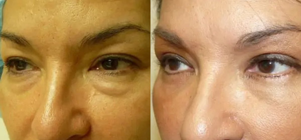 Blepharoplasty Case #2080