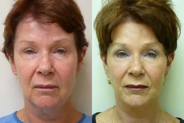 Facelift Case #2032