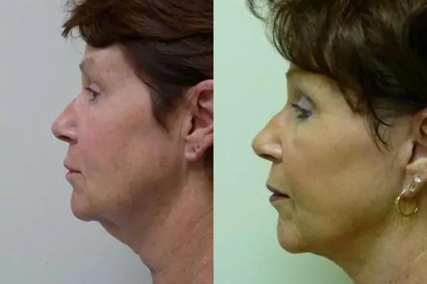 Facelift Case #2032