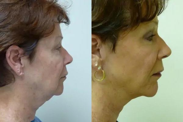 Facelift Case #2032